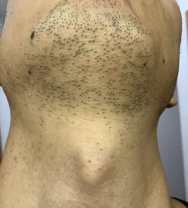 ケノン脱毛　7回目照射完了から7日後のヒゲ(あご、あご下）の毛の状態２