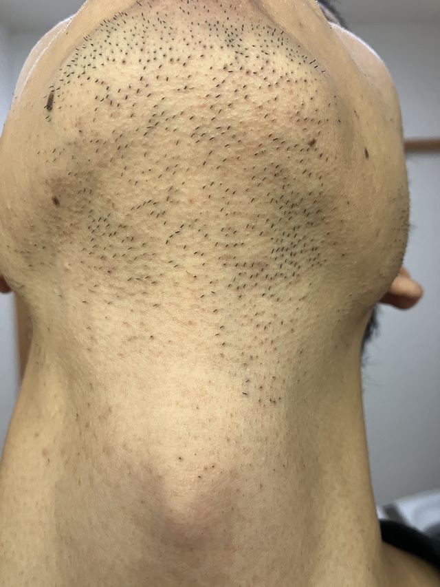 ケノン脱毛　8回目照射完了から7日後のヒゲ(あご、あご下）の毛の状態2