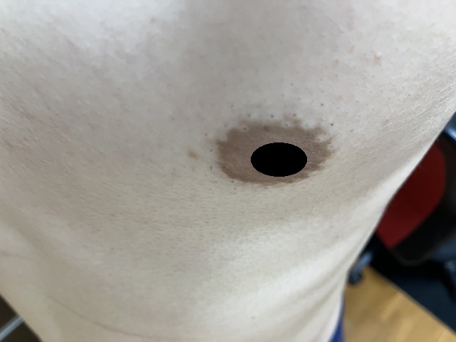ケノン脱毛　2回目照射完了から14日後の乳輪周辺の毛の状態1