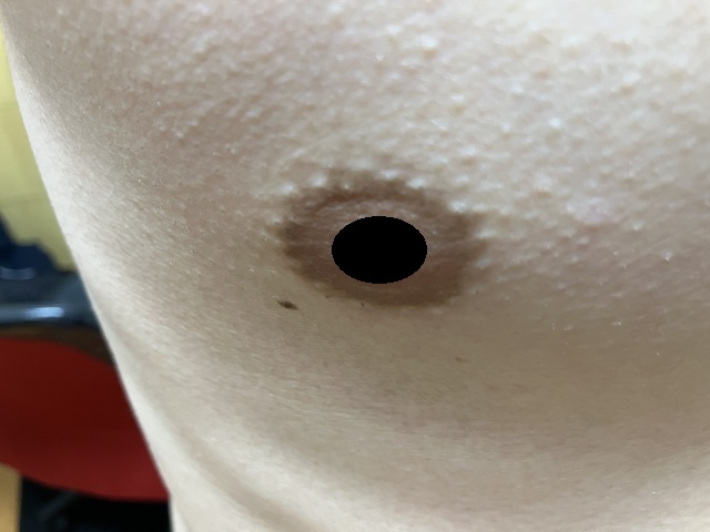 ケノン脱毛　2回目照射完了から14日後の乳輪周辺の毛の状態2