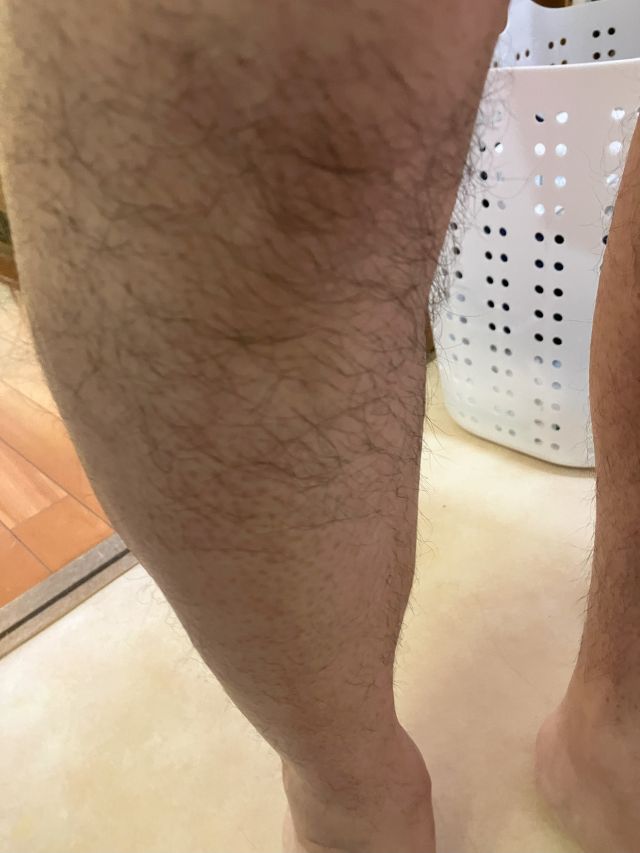 ケノン脱毛　1回目照射前のすねのムダ毛状態