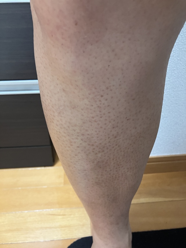 ケノン脱毛　4回目照射後から6日後のすね・膝のムダ毛状態