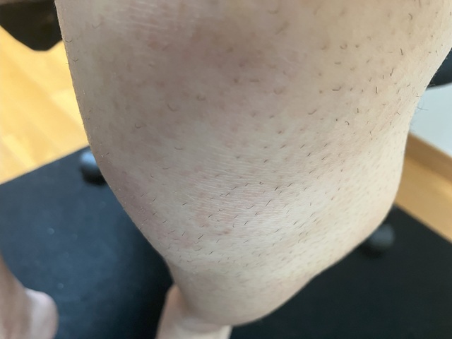 ケノン脱毛　2回目照射前のすね・膝のムダ毛状態2