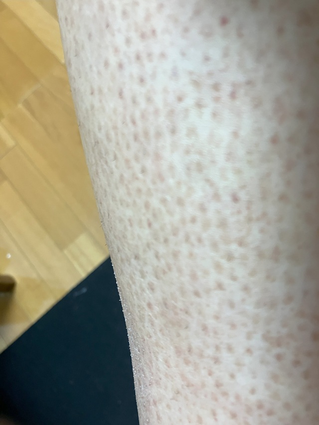 ケノン脱毛　3回目照射前のすね・膝のムダ毛状態