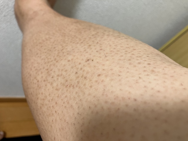 ケノン脱毛　5回目照射前のすね・膝のムダ毛状態