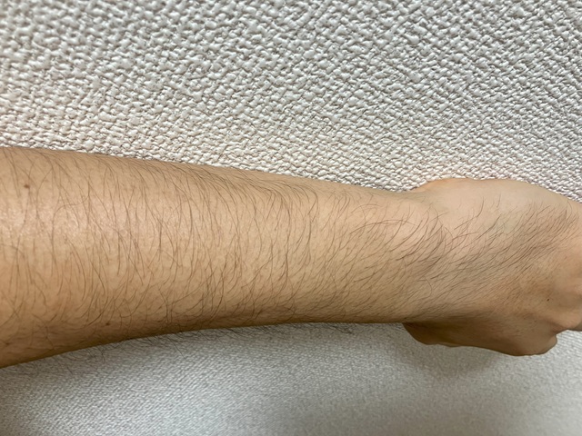 ケノン脱毛　1回目照射前の腕のムダ毛の状態
