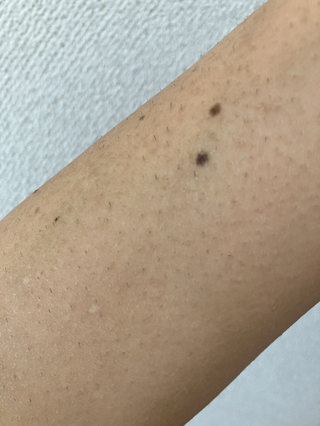 ケノン脱毛　1回目照射後6日後の腕のムダ毛の状態1