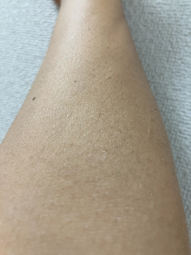 ケノン脱毛　2回目照射後8日後の腕のムダ毛の状態2