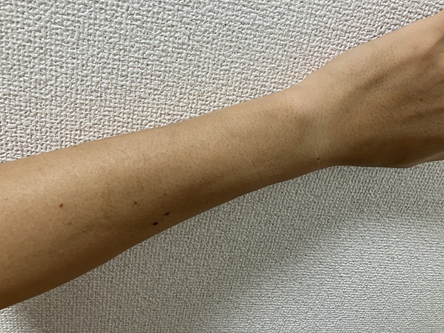 ケノン脱毛　3回目照射後14日後の腕のムダ毛の状態1