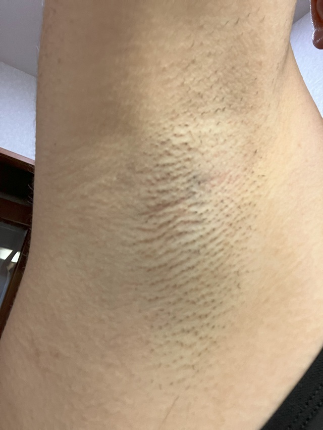 ケノン脱毛　3回照射前のわき毛の状態