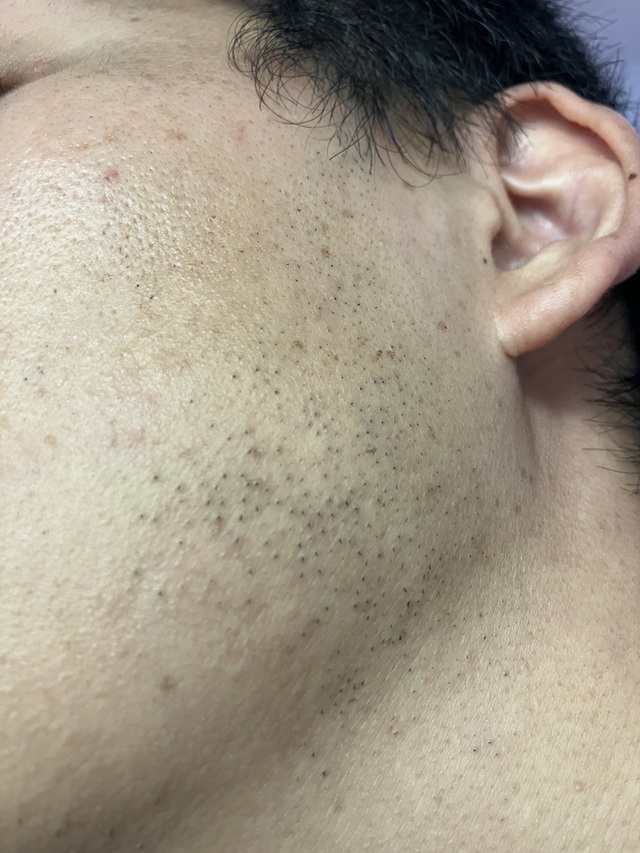 ケノン脱毛　9回目照射から7日後のヒゲ(左頬、首）の毛の状態