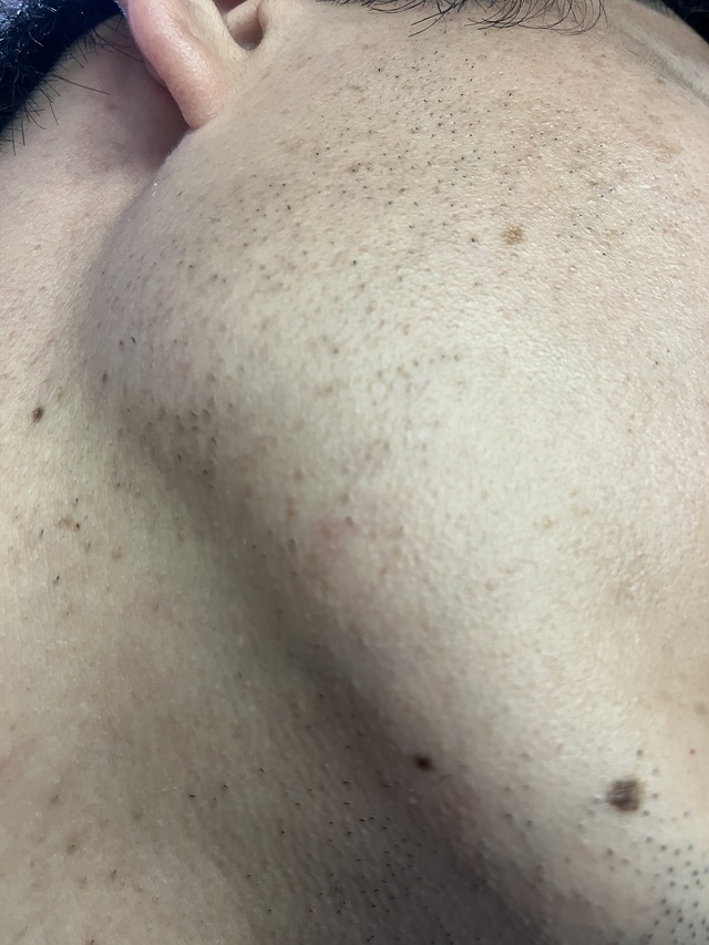 ケノン脱毛　9回目照射から7日後のヒゲ(右頬、首）の毛の状態