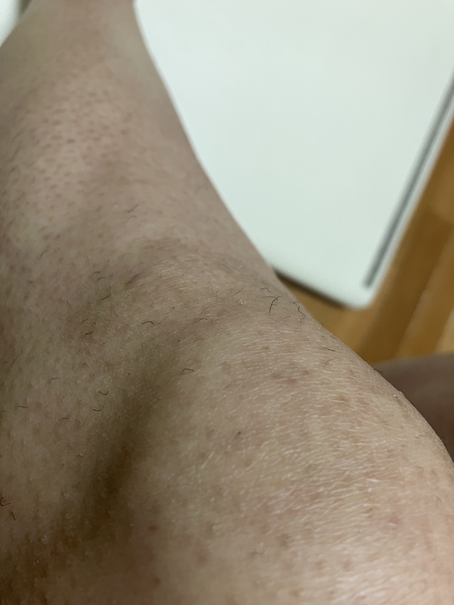 ケノン脱毛 6回目照射後から15日後のすね・膝のムダ毛状態