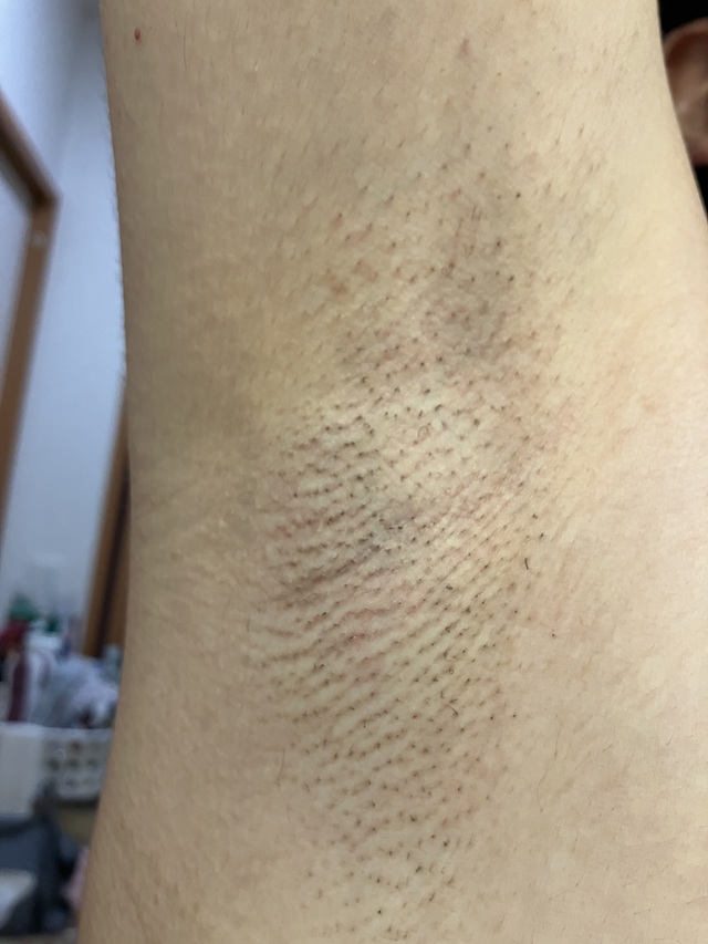 ケノン脱毛 7回目照射直後