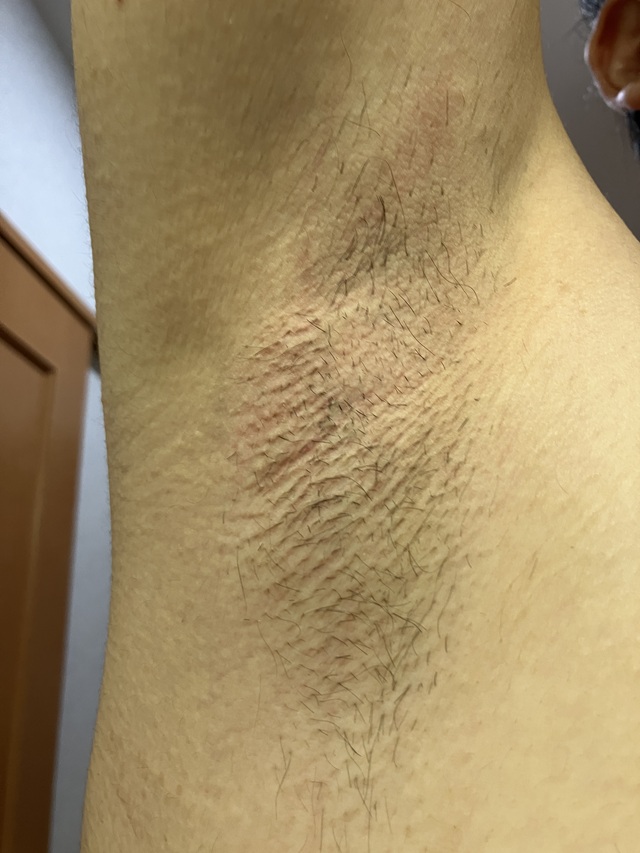 ケノン脱毛 6回目照射後から283日後のわき毛の状態_7回照射前_剃毛後