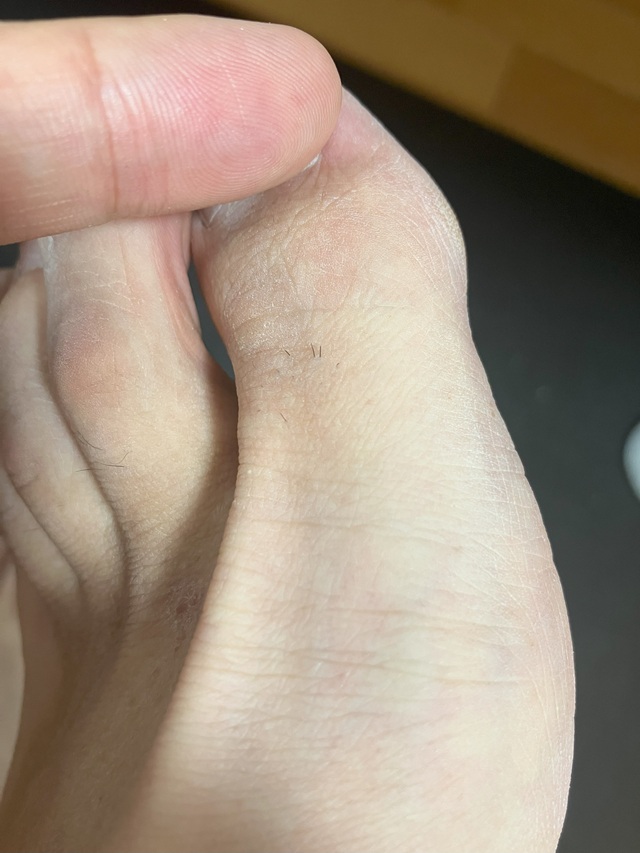 ケノン脱毛中　足の指のムダ毛の状態