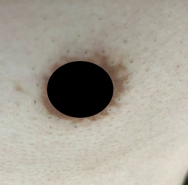 ケノン脱毛１ヶ月後　乳首（乳輪）まわりの状態